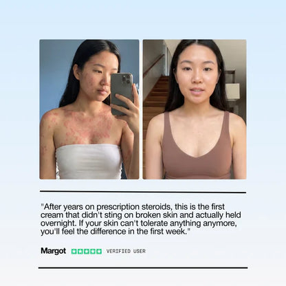 Lumora Eczema Treatment