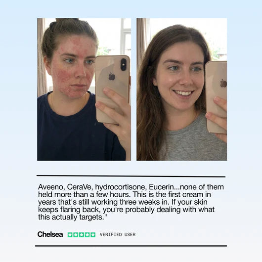 Lumora Eczema Treatment